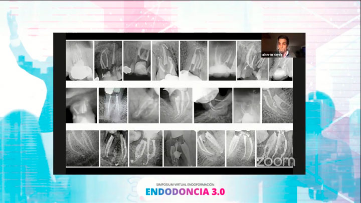 caso-clinico-ponencia-alberto-sierra-endodoncia3cero