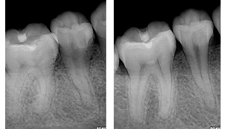 ZARC-caso-clinico-radiografia-diagnostico-bifurcacion