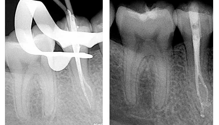 zarc-caso-clinico-radiografia-bifurcacion-tercio-medio-tratamiento-02