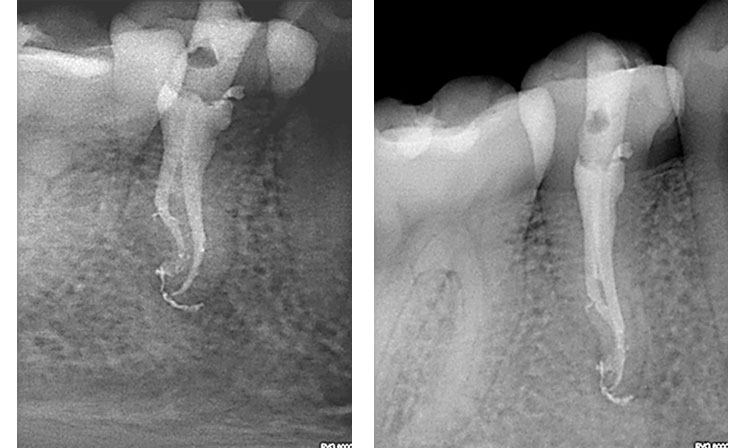 zarc-caso-clinico-radiografia-bifurcacion-tercio-medio-tratamiento-03