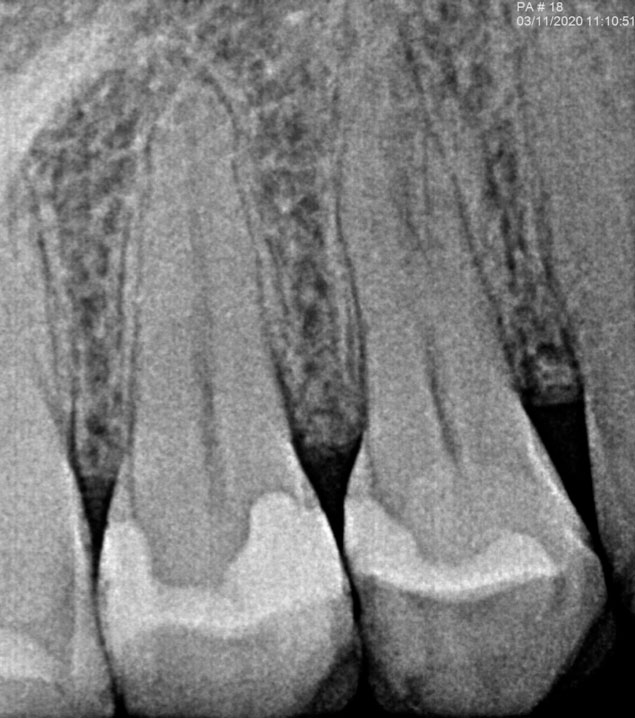 ZARC-caso-clinico-radiografia-diagnostico-complejidad-conductos