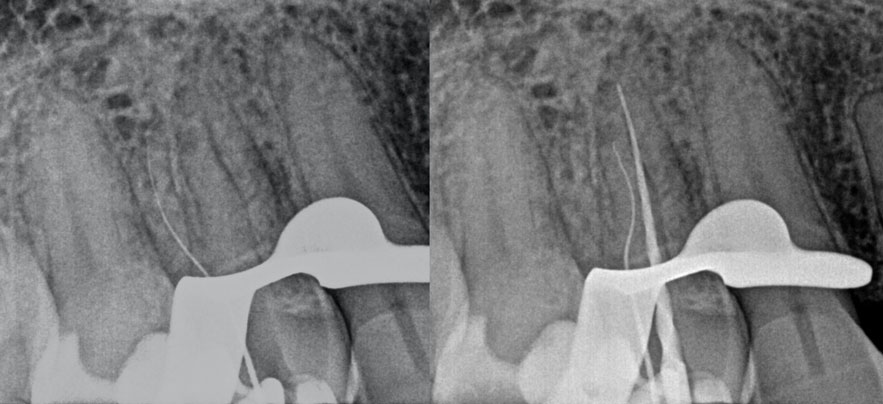 Zarc-caso-clinico-conductos-distovestibular-mesiovestibular