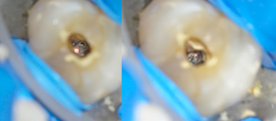 zarc-caso-clinico-imagen-obturacion-conductos-distovestibular-y-mesiovestibular