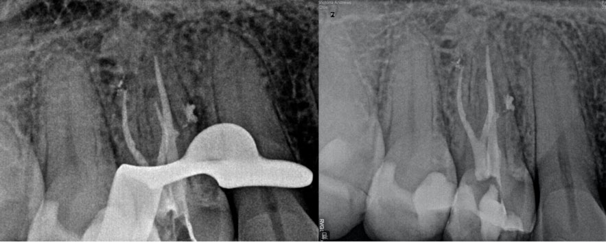 zarc-caso-clinico-radiografias-posoperatorias