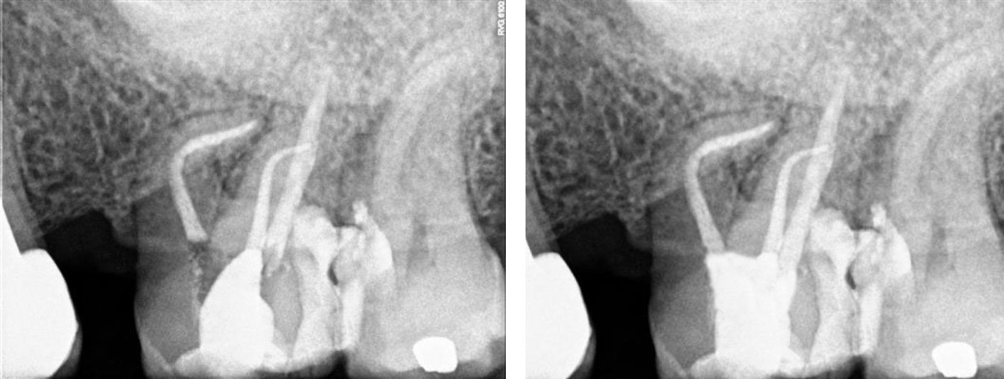 Radiografía final y Radiografía de control tras 6 meses