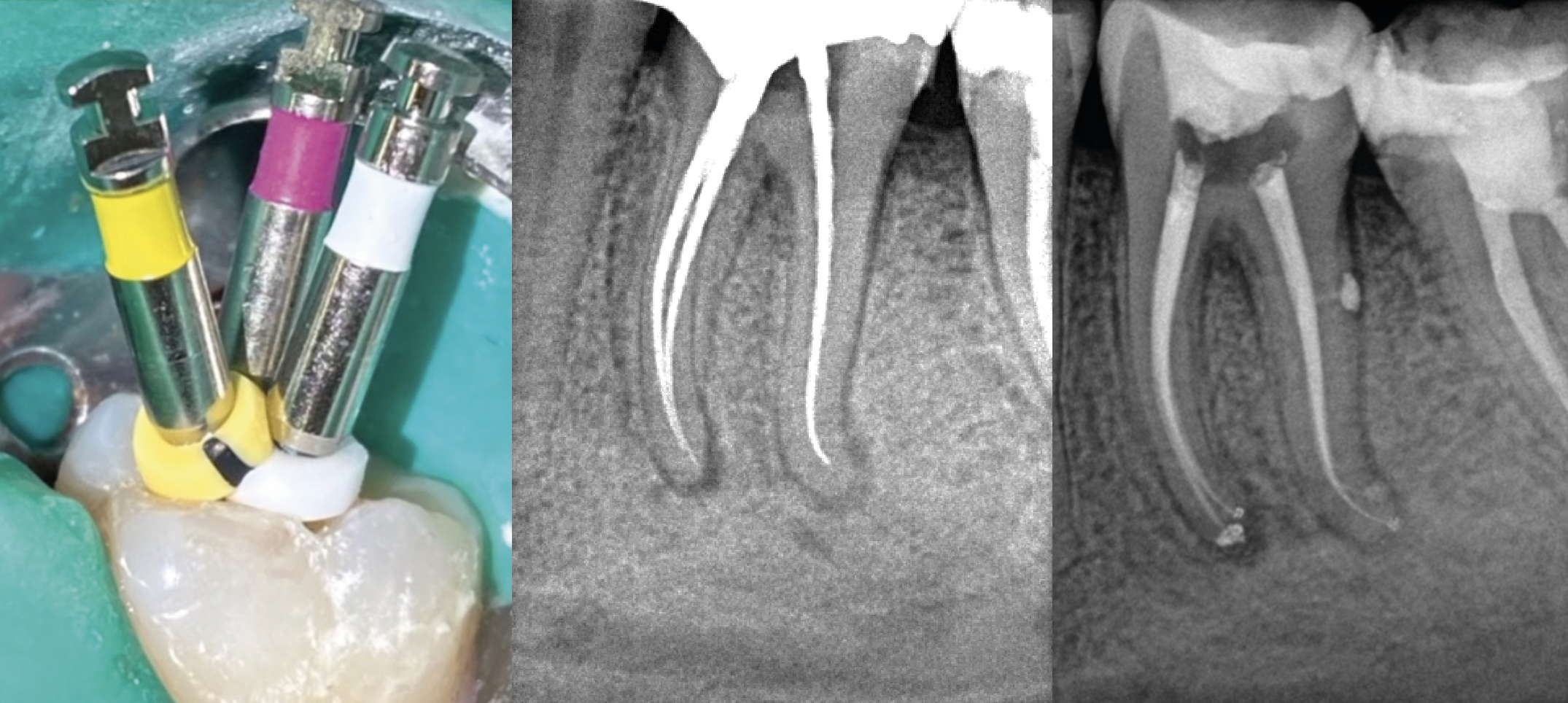 Secuencia radiografías tratamiento pulpitis con BlueShaper