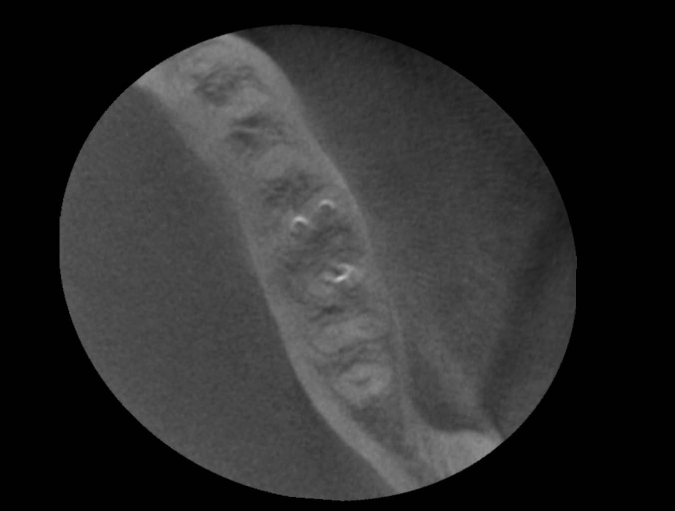 Plano axial del tercio medio donde se puede observar la existencia de cortical alrededor de las raíces, descartando la presencia de fisuras o fracturas verticales.