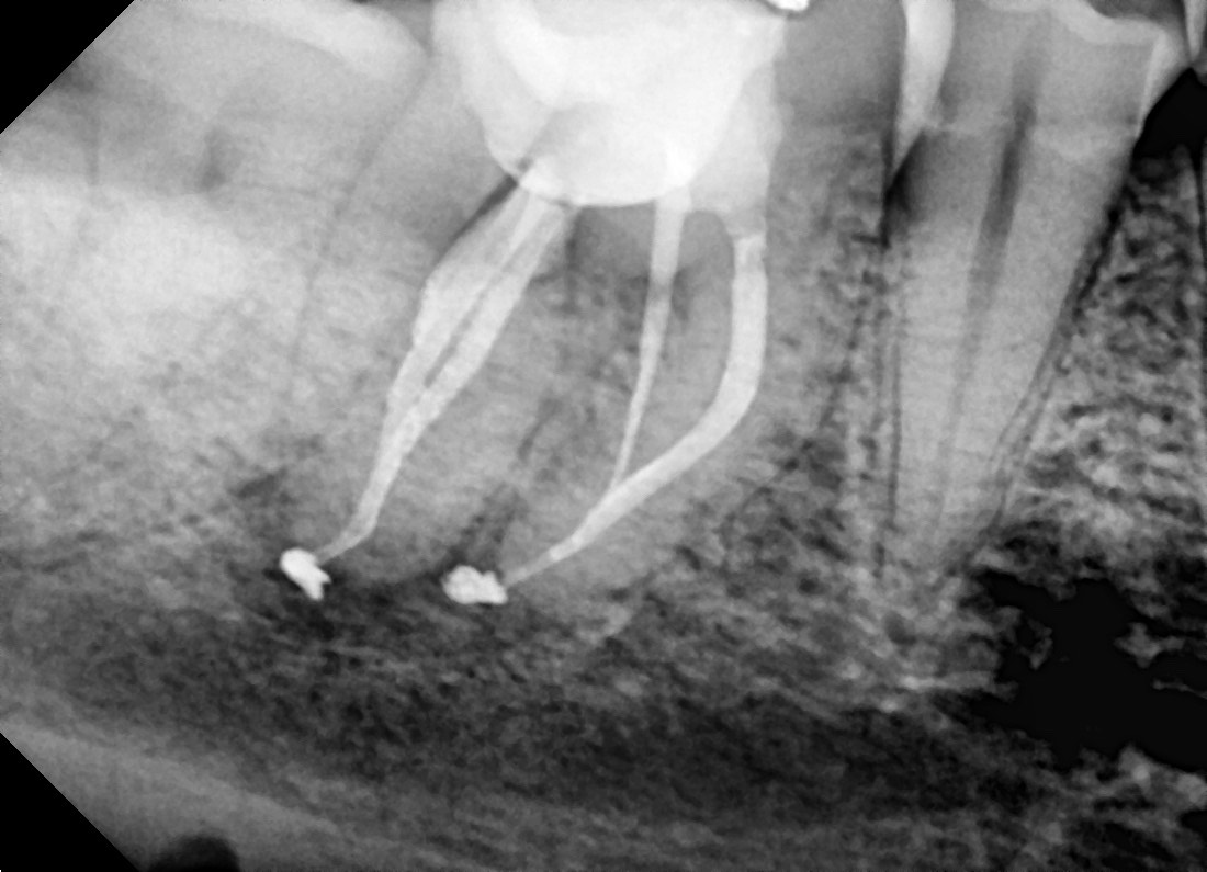 Fig. 3 Radiografía final mesial