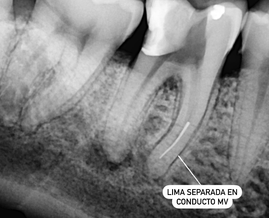 Radiografía inicial. Lima fracturada en conducto MV