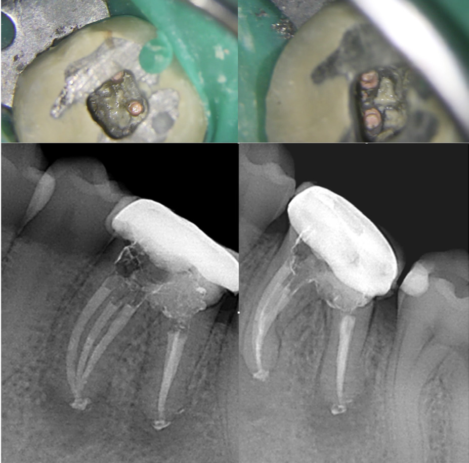 Imágenes al microscopio óptico y radiografías, donde podemos observar el sellado tridimensional del entramado radicular