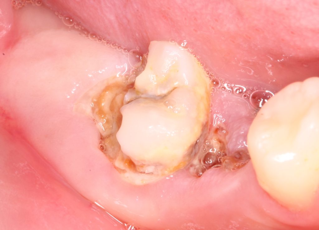 fotografía pretratamiento periodontitis