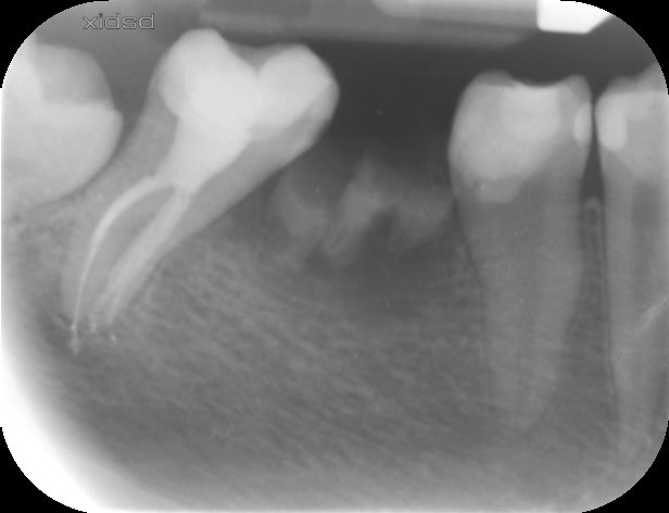 final periodontitis