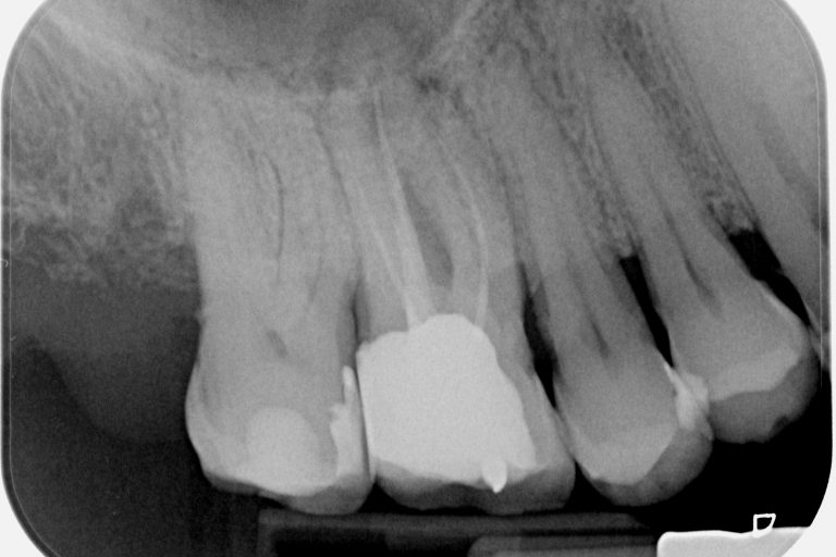 Radiografía inicial donde se observa lesión apical en el 1.6 Figura 2. Radiografía inicial donde se observa lesión apical en el 1.6