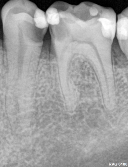 Molar 35 rx preoperatoria