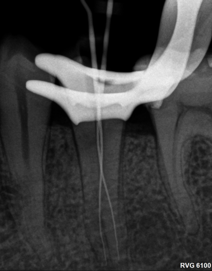Molar 35 rx conductometria