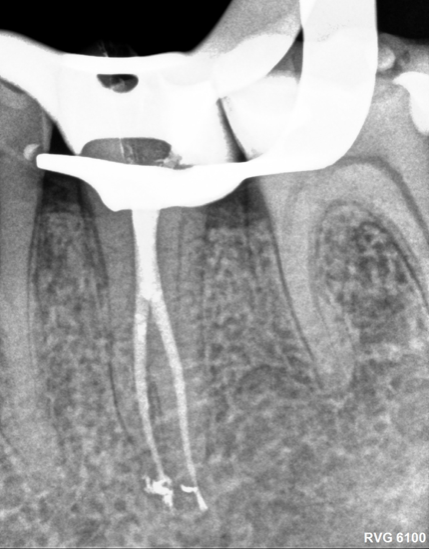Molar 35 rx postoperatoria 2