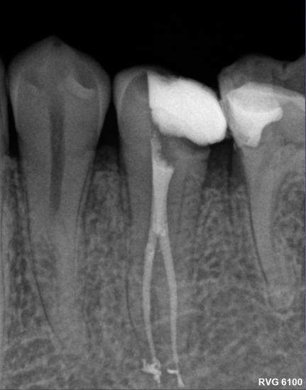 Molar 35 rx postoperatoria